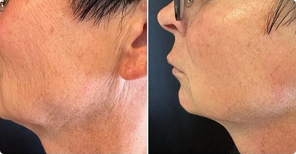 T Shape Before & After