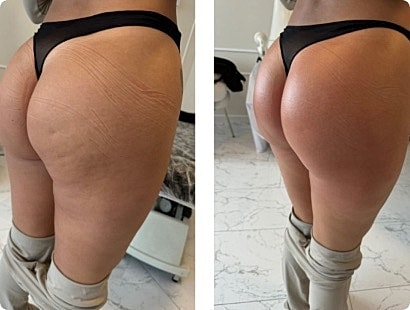 T Shape Before & After