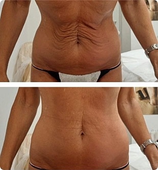 T Shape Before & After