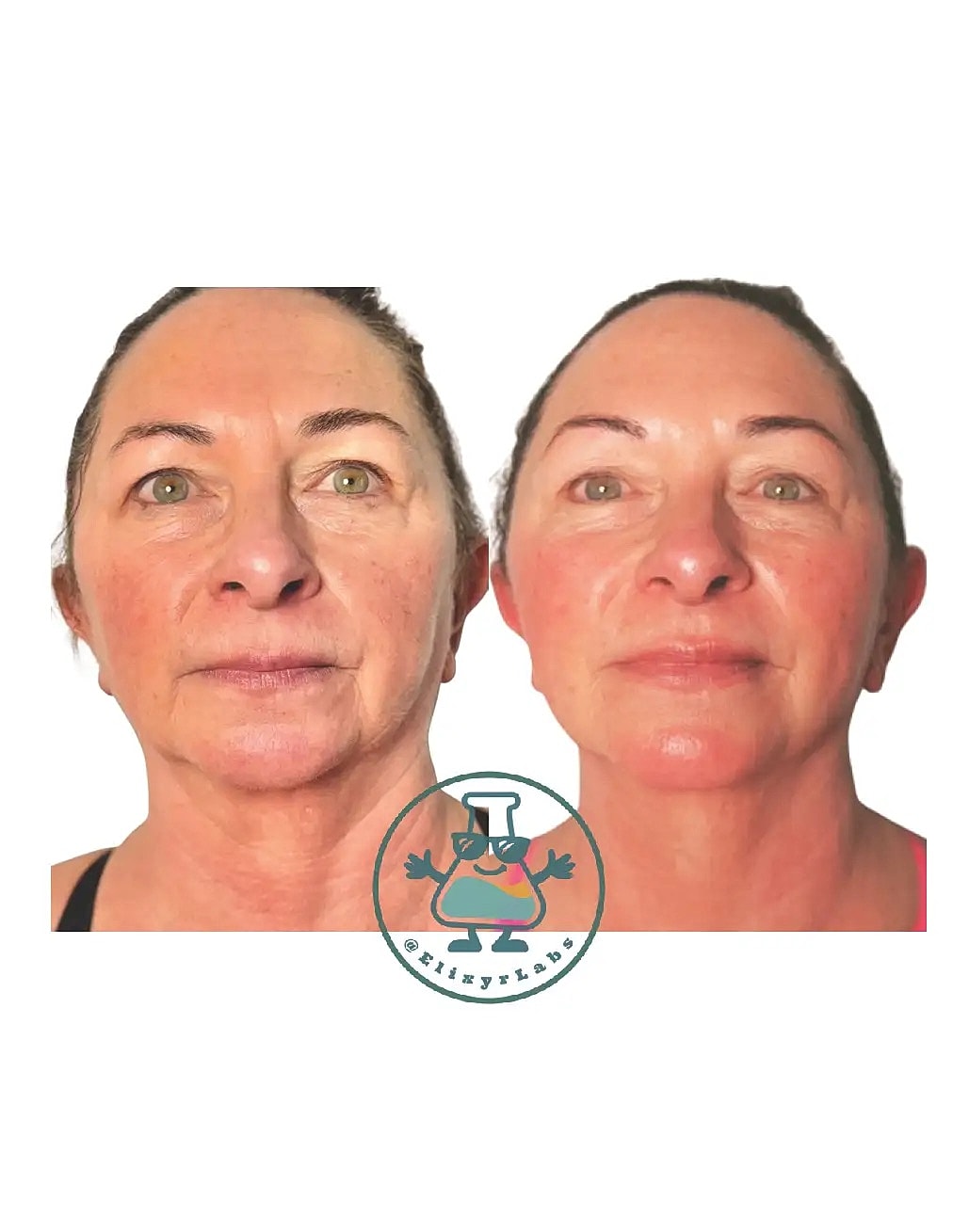 T Shape Before & After