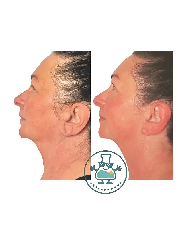 T Shape Before & After