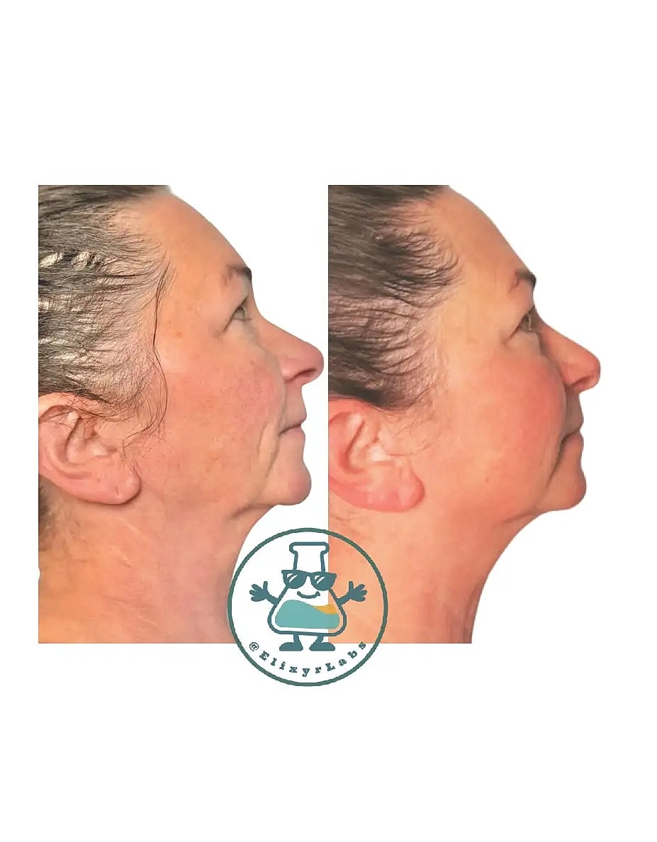 T Shape Before & After