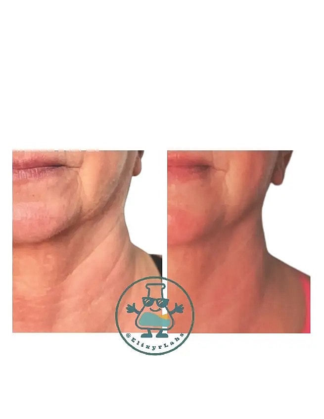 T Shape Before & After