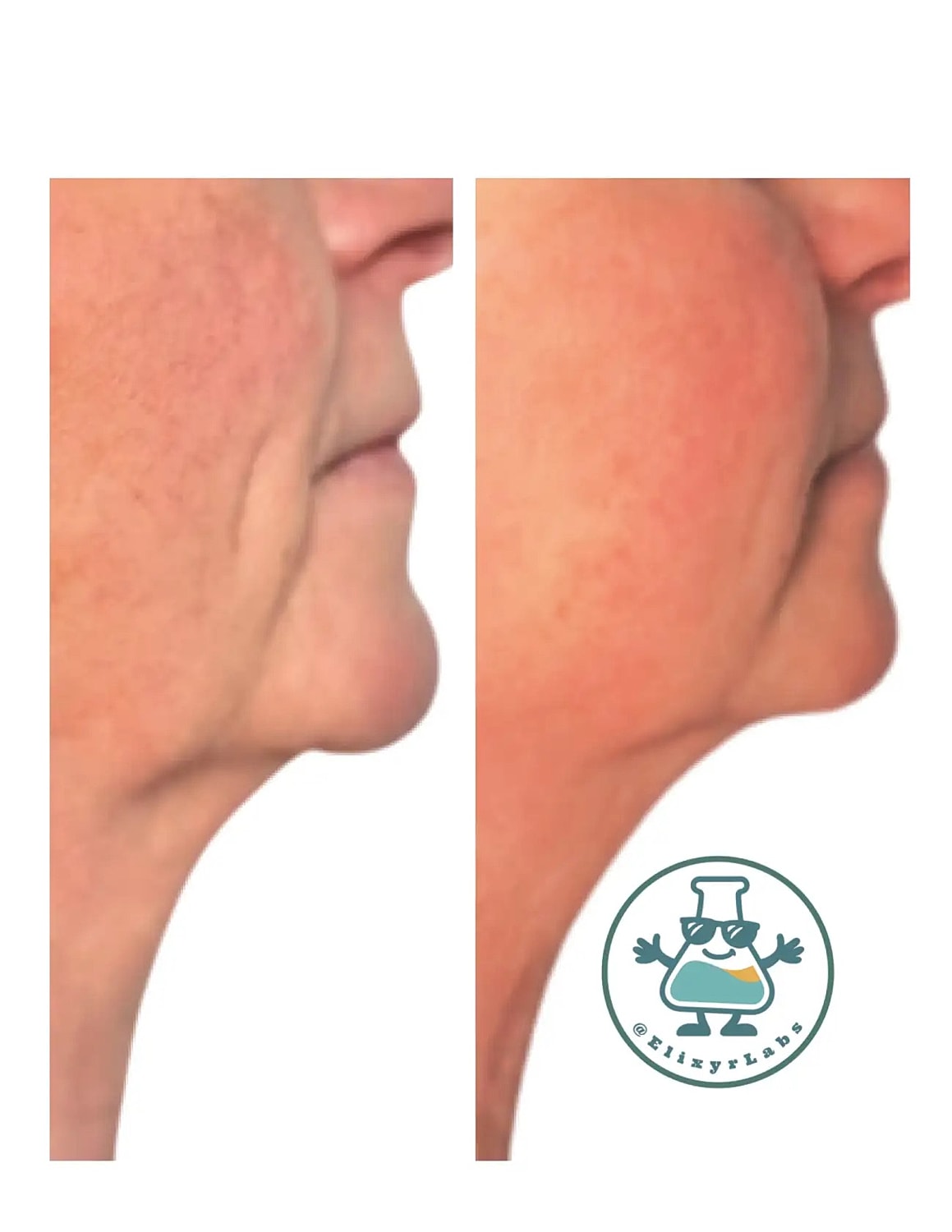 T Shape Before & After