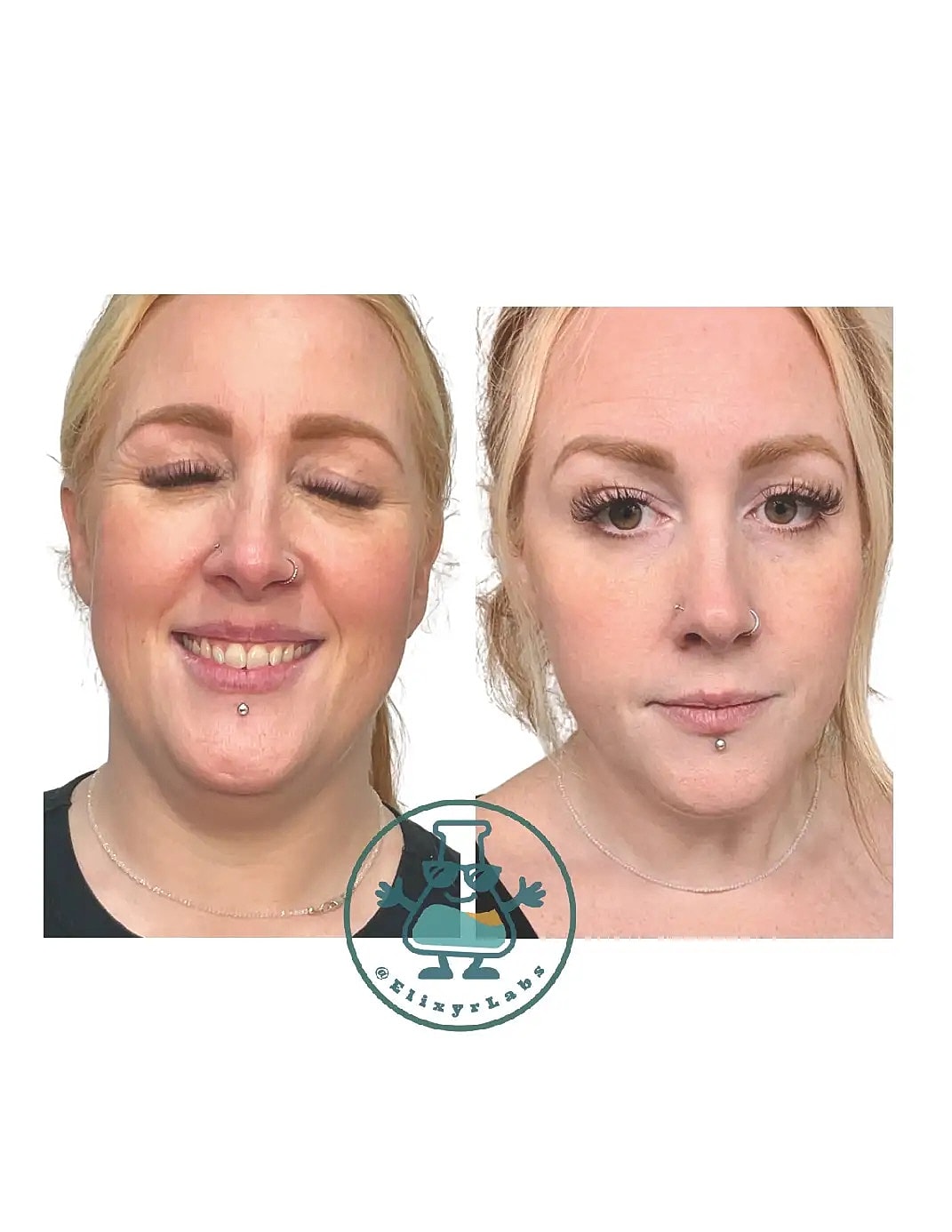 T Shape Before & After