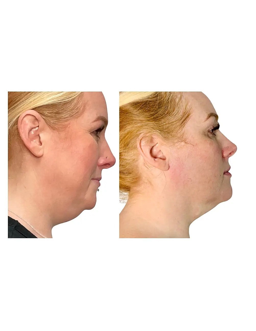 T Shape Before & After