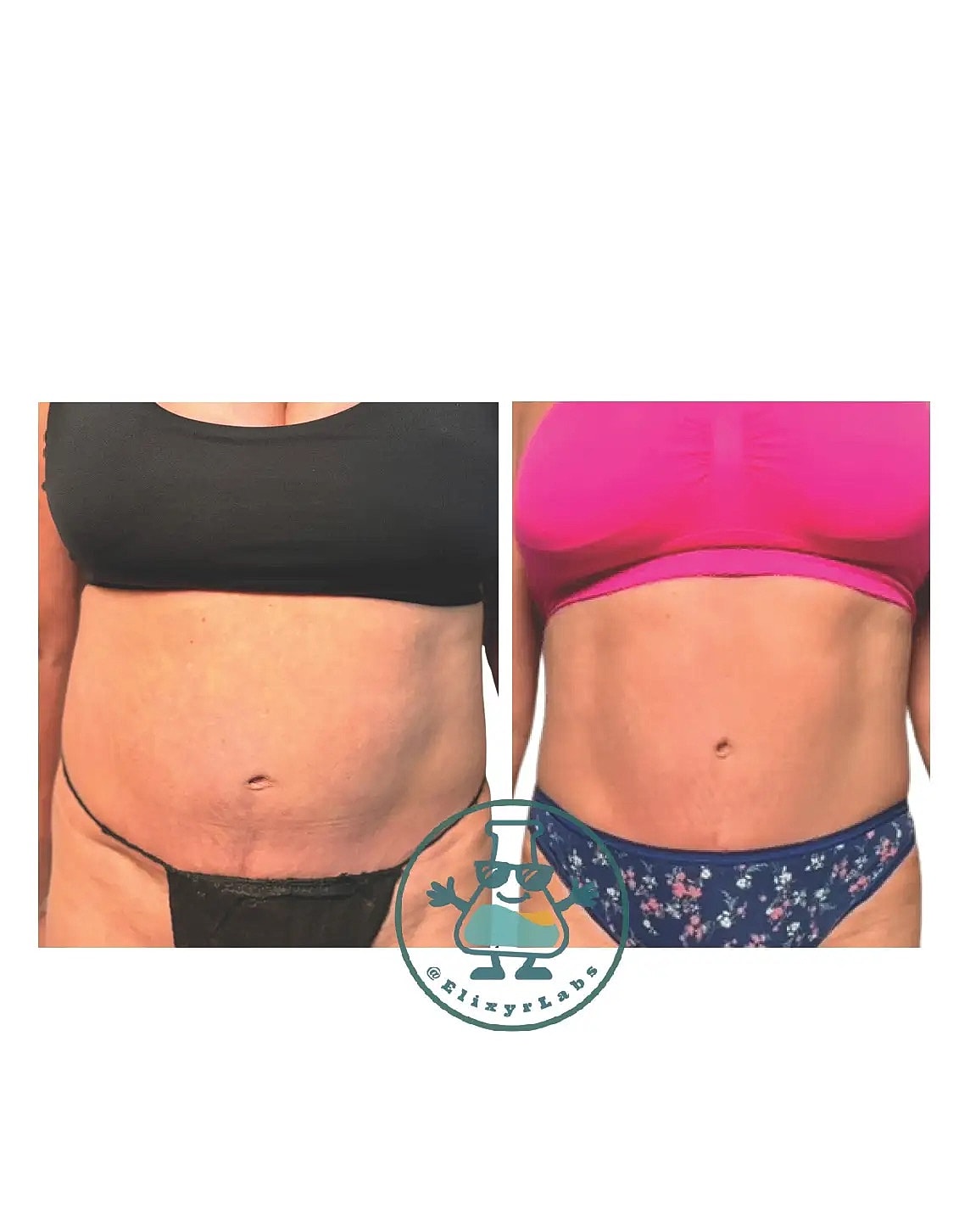 T Shape Before & After