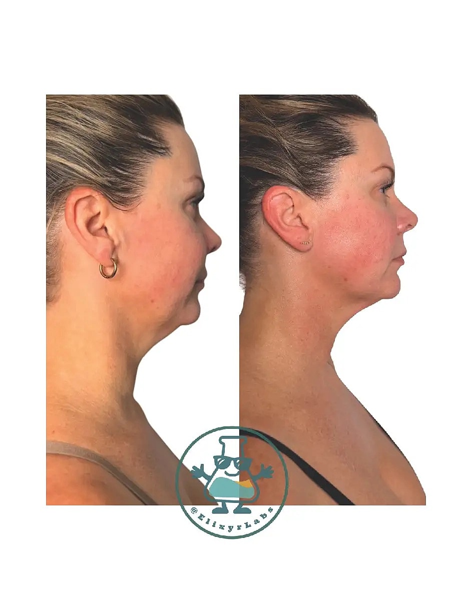 T Shape Before & After