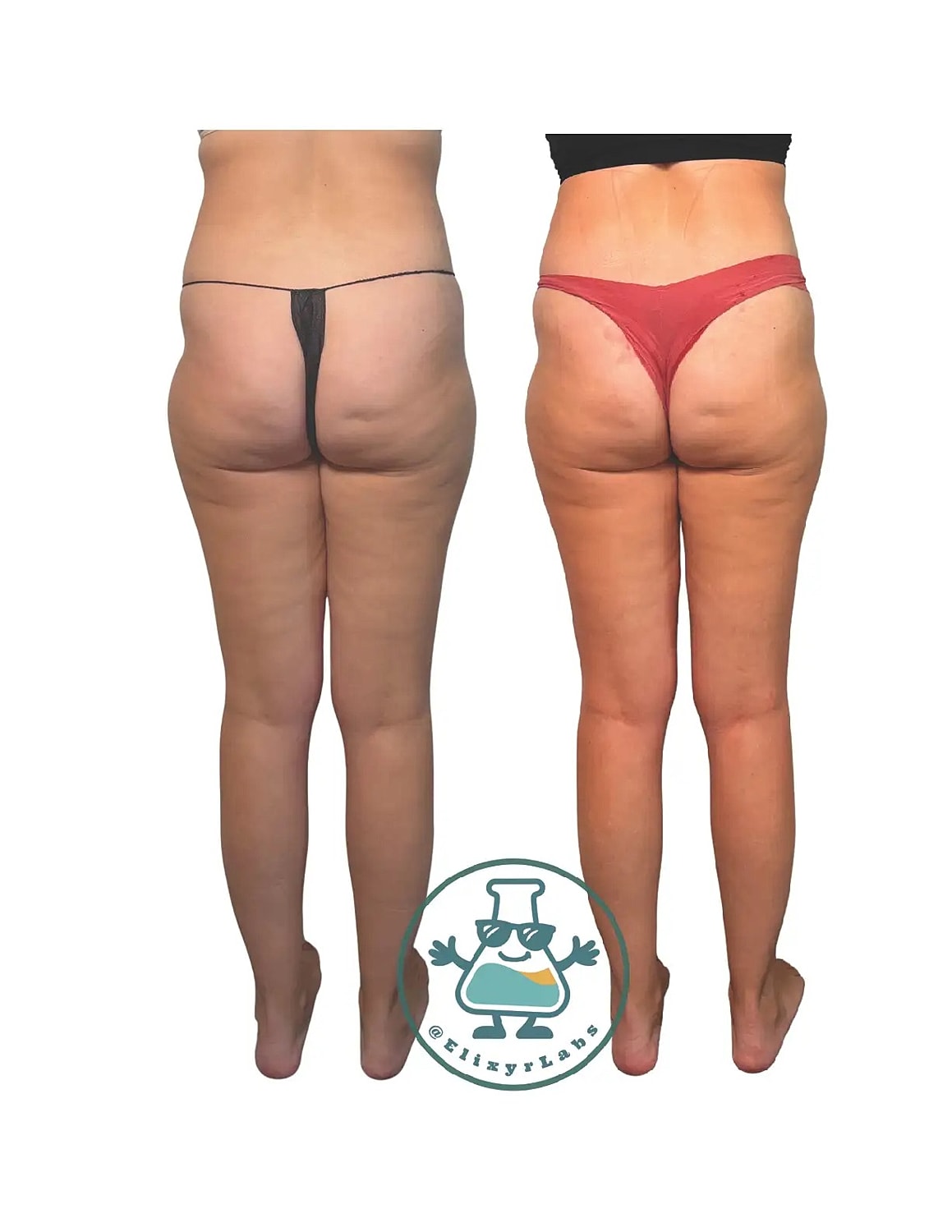 T Shape Before & After