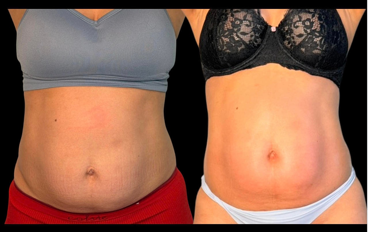 Before and after body transformation comparison.
