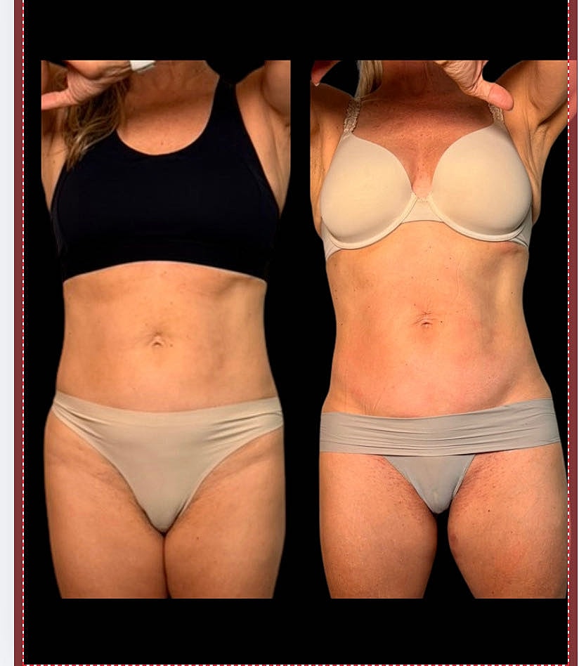 Comparison of two body types in underwear.