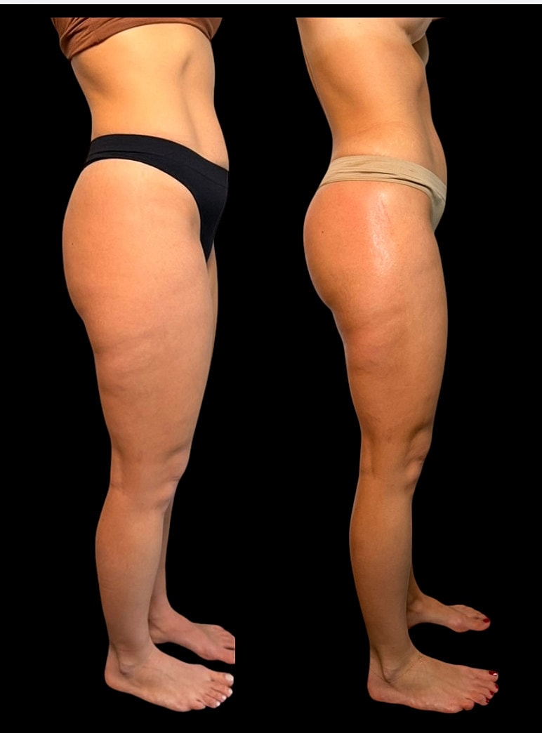 Side profile comparison of two female legs.