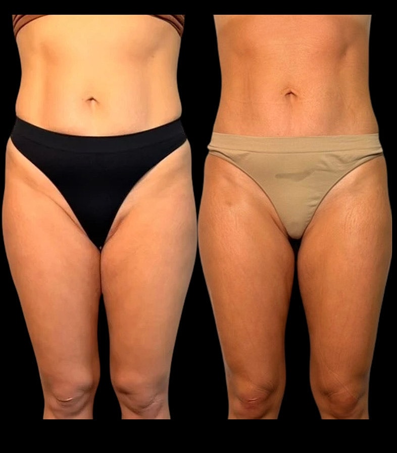 Comparison of two thong bikini styles.