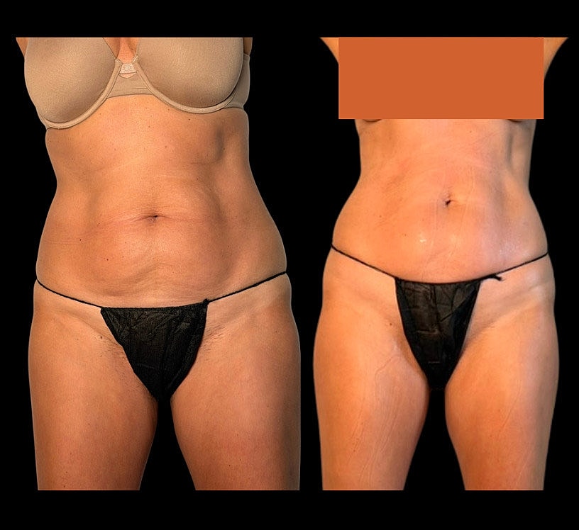 Before and after body transformation comparison.