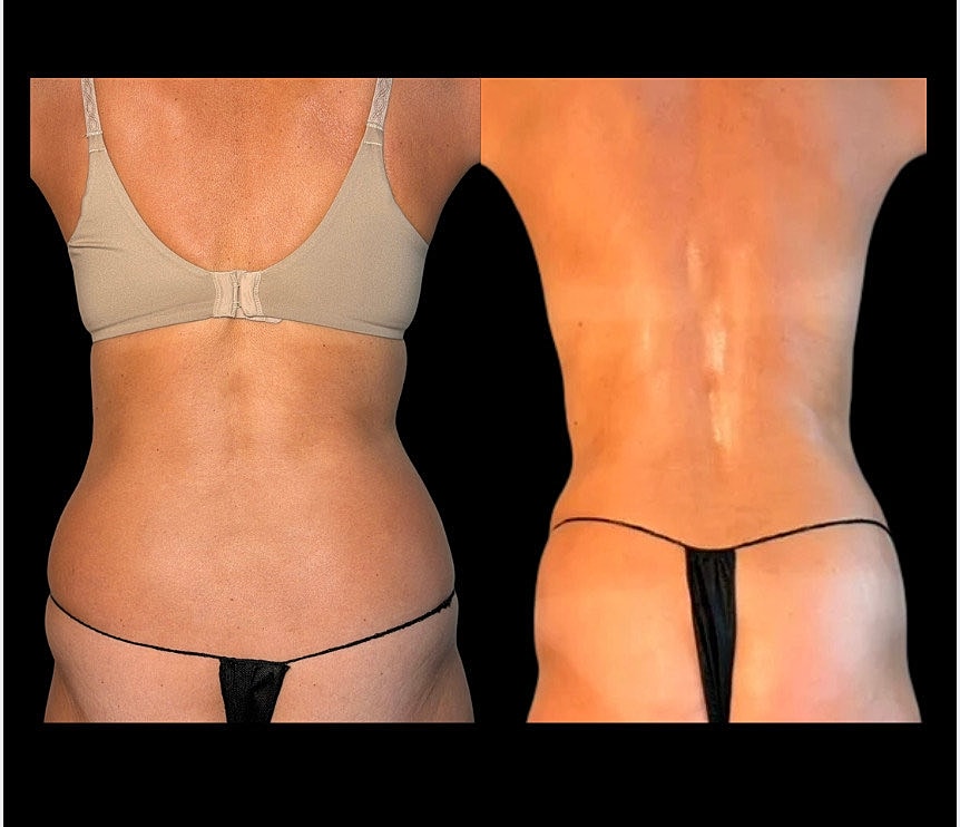 Before and after body contouring transformation photo