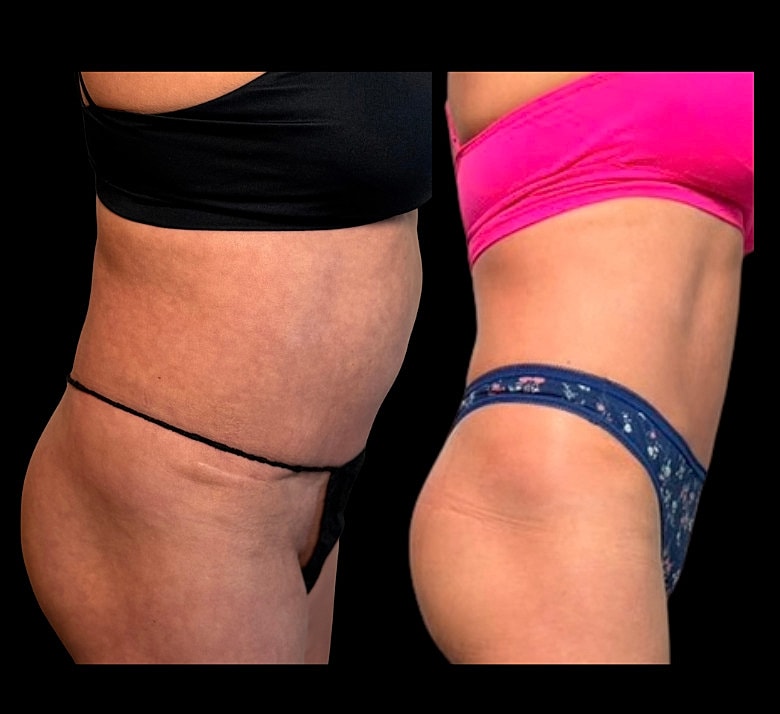 Before and after body transformation comparison.