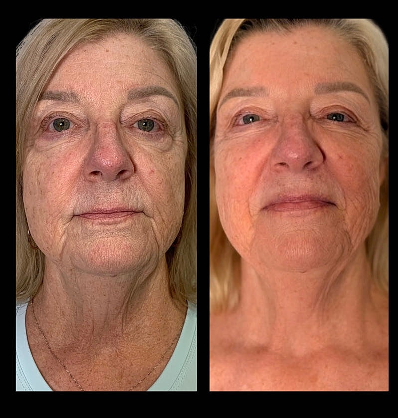 Before and after facial rejuvenation treatment results.