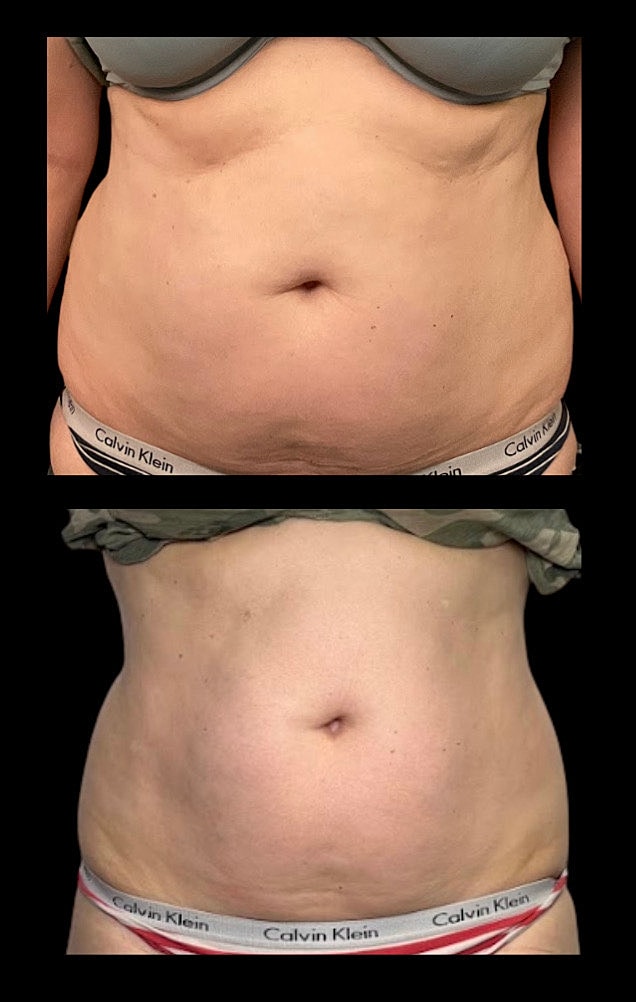 Before and after body image comparison.