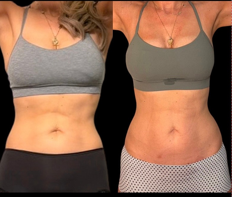 Comparison of two women's midsections side by side.